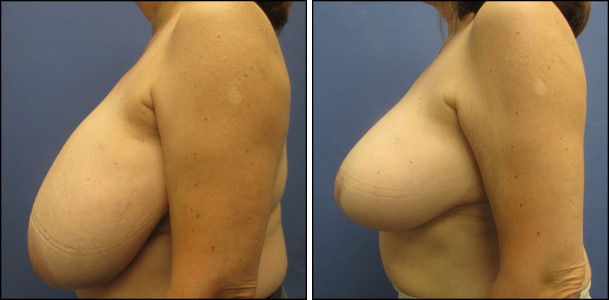 BreastReduction
